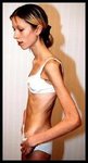80s%20-%20katie%20-%20anorexic15.jpe