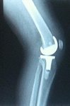 knee x-ray.jpg