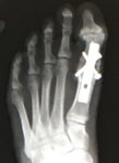 right foot xray.jpg