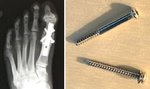 left foot xray.jpg