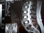 foto-hernia.jpg