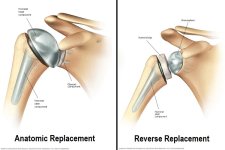 shoulder replacement.jpg