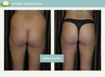 buttock-augmentation-ashburn-virginia.jpg