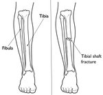 Tibia-fracture-diagram.jpg Tibia-fracture-diagram.jpg