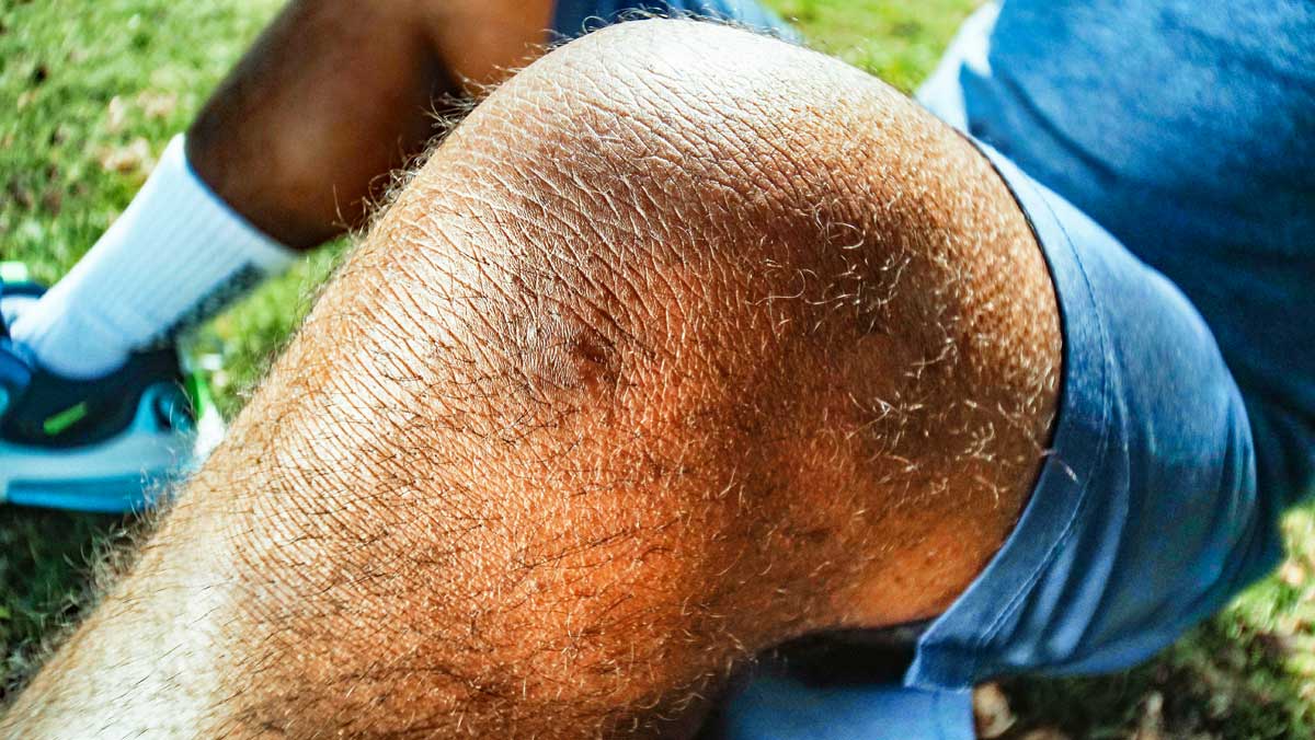 Desgarro del ligamento cruzado anterior: Una lesión deportiva común