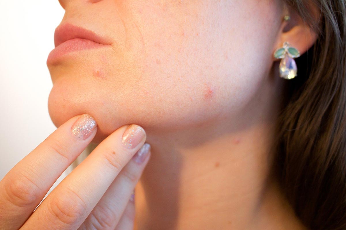 Vitamin E for Acne: Unlocking the Secrets to Clear Skin