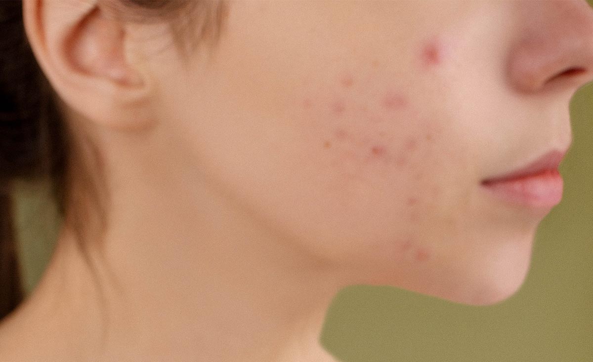 Can Your Acne Stem from Colon Health?