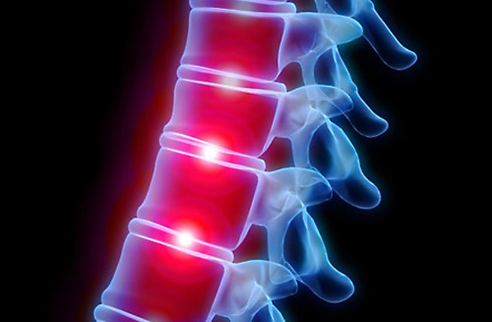 Bandscheibenvorfall: Endlich schmerzfrei dank Physiotherapie