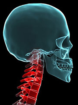 Terapia y ejercicios contra el Síndrome Cervical